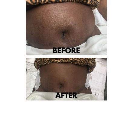 lymphatic drainage massage in Altamonte Springs Florida